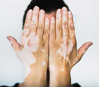 Choix pour un don Vitiligo